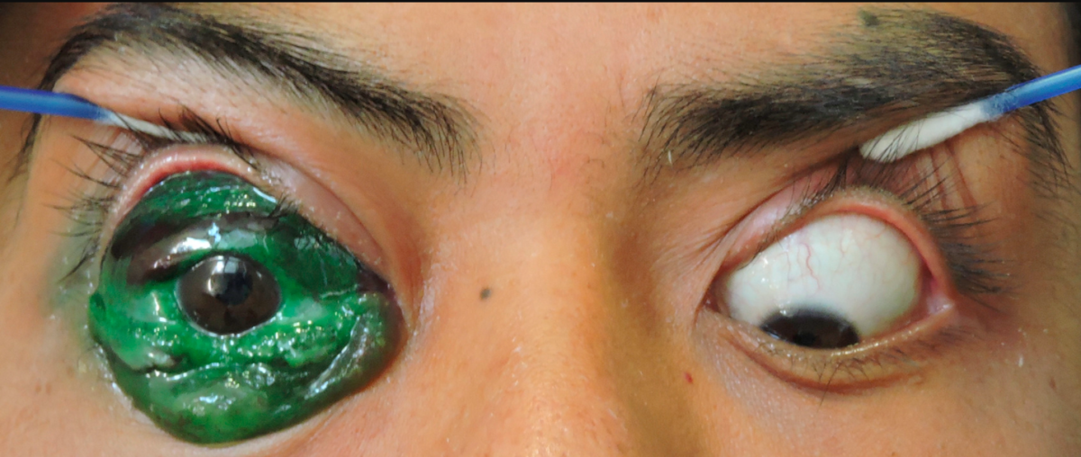 Eye Tattoos Cause Complications - Marianas Eye Institute